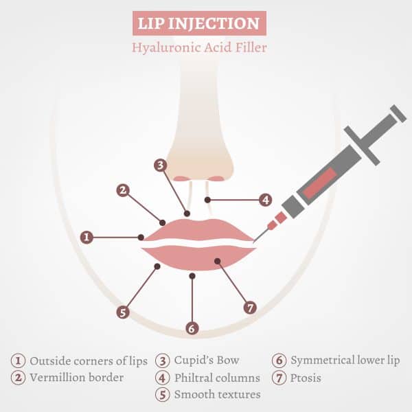 diagram showing the benefits of hyaluronic acid filler treatments on lips