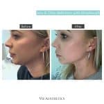 morpheus8 before and after essex vie aesthetics