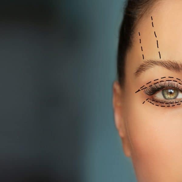 woman with brow or eye lift markings