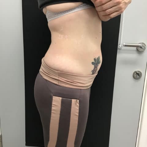 Vanessa’s VieMax Sculpt EMS Case Study