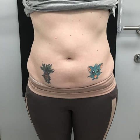 woman with flabby stomach before viemax sculpt treatment for abdomen