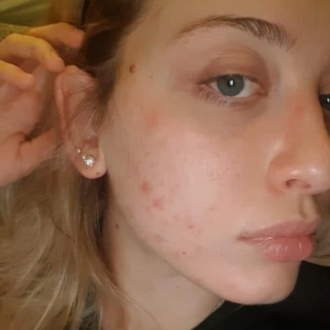 day 4 of chemical peel recovery for acne