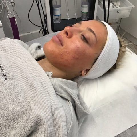 woman during perfect peel treatment for acne