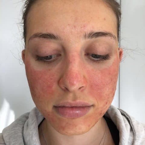 woman directly after perfect peel acne treatment