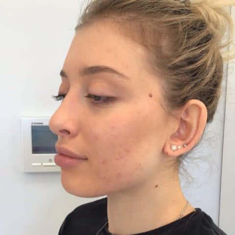 Young woman with acne has clear skin after perfect peel treatment