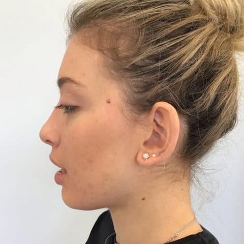 Girl with acne has clear skin after chemical peel treatment