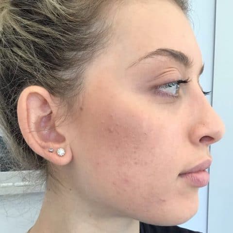 Woman clears acne condition with perfect peel treatment