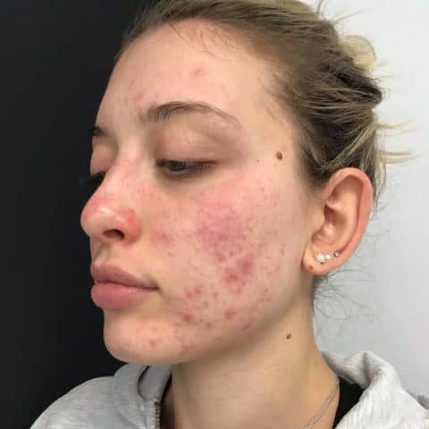 Girl in 20s before perfect peel treatment for acne