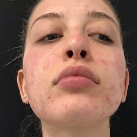 woman in her 20s with acne