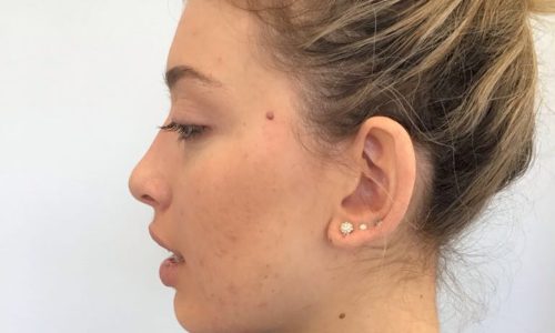 Anna’s Perfect Peel Case Study