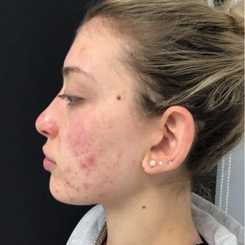 Girl in 20s with acne before chemical peel