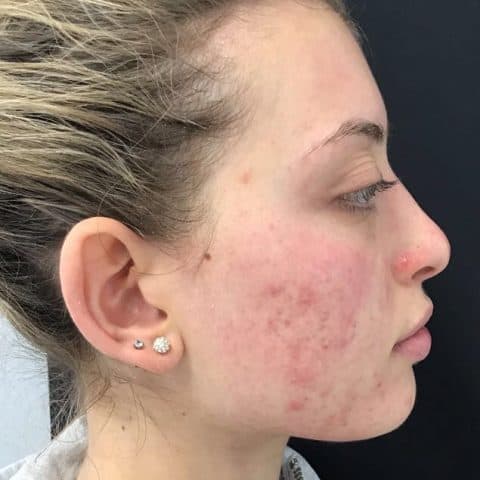 20-year-old with acne condition