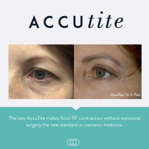 AccuTite™ Skin Tightening