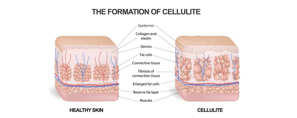 diagram comparing skin with cellulite to healthy skin