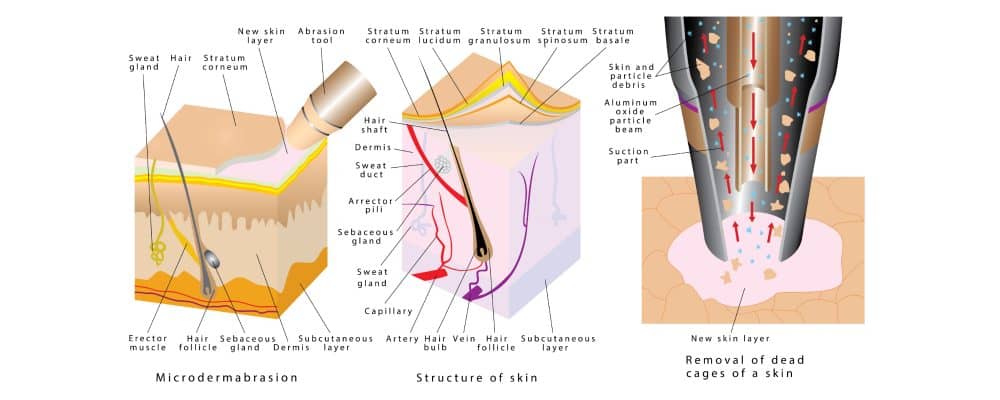 diagram showing benefits of microdermabrasion treatment