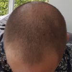 man with thinning crown caused by male pattern baldness