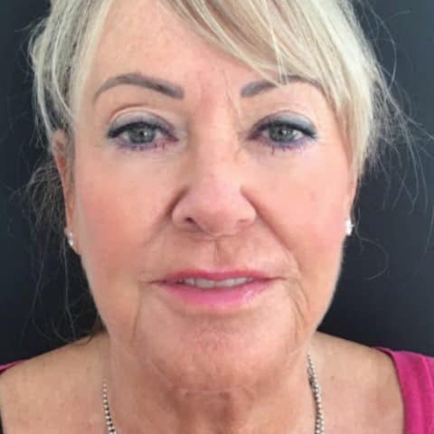 Woman in her 60s after Silhouette Soft Thread Lift and Ellanse for sagging skin in the face