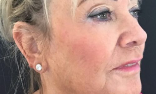 Pam’s Thread Lift and Filler Case Study