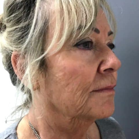 Woman in her 60s getting treatment for sagging skin in the face