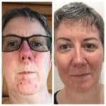 Before and After WOW Facial Vie Aesthetics