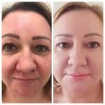 WOW facial Before and After Vie Aesthetics