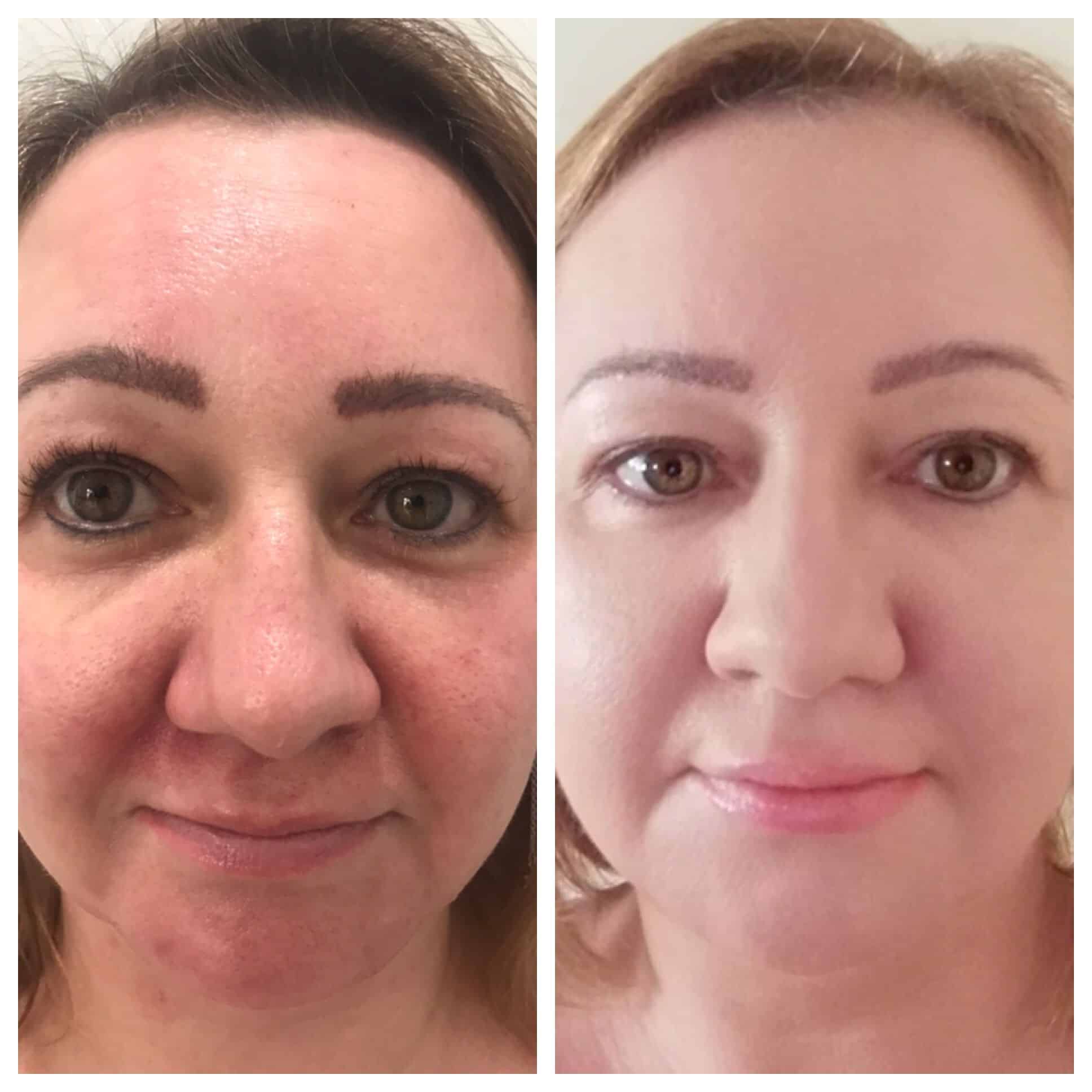 WOW facial Before and After Vie Aesthetics