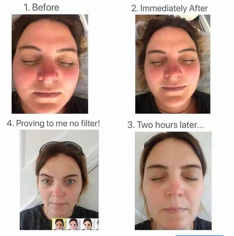 WOW Facial Before and After Vie Aesthetics