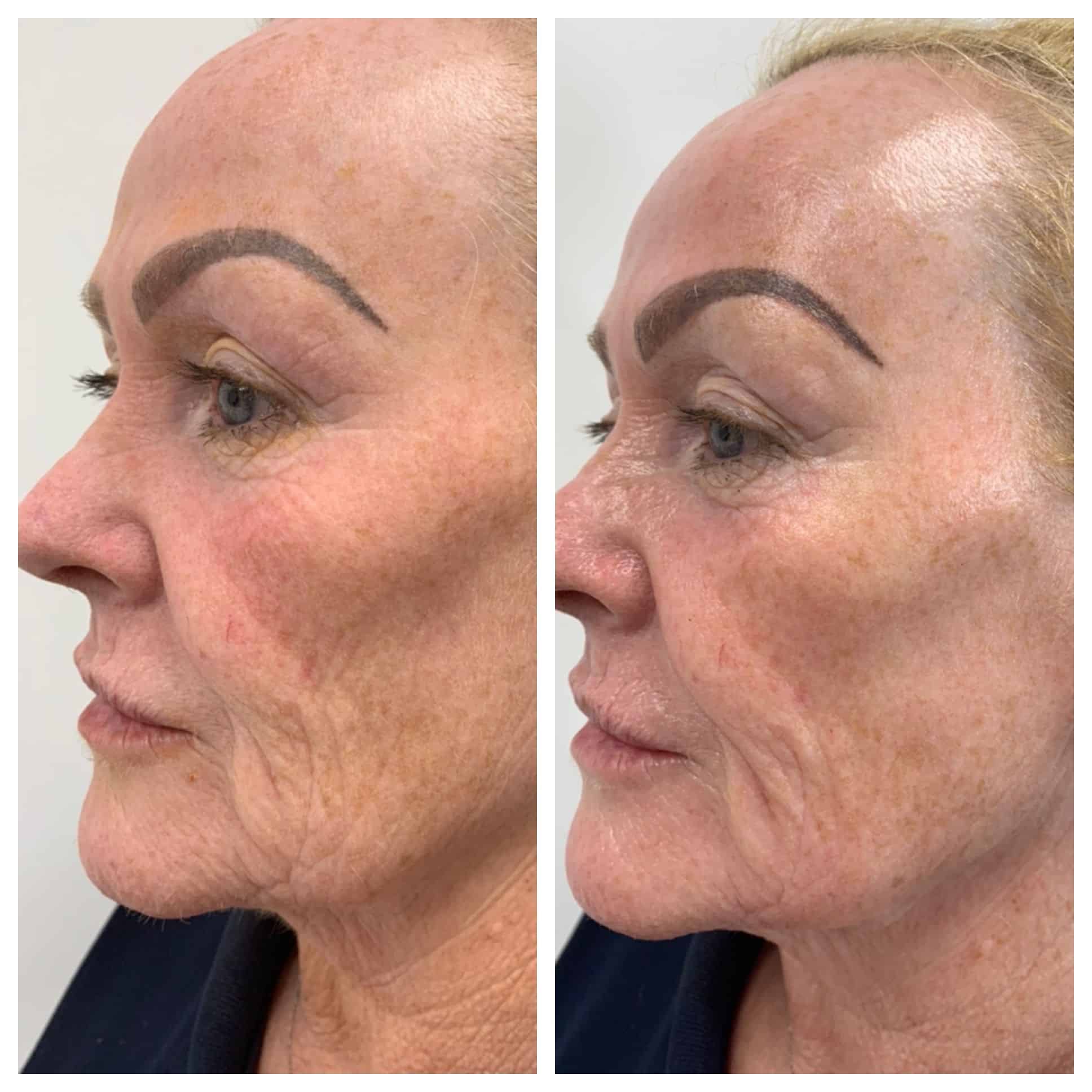 WOW facial Before and After Vie Aesthetics