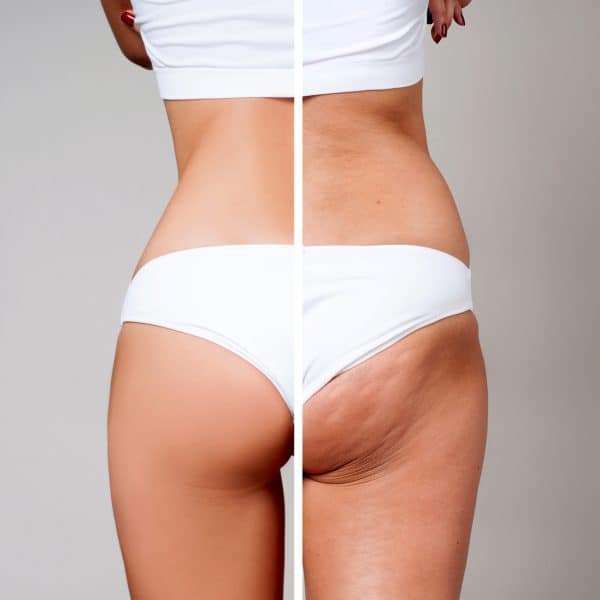 before and after non-surgical cellulite treatment