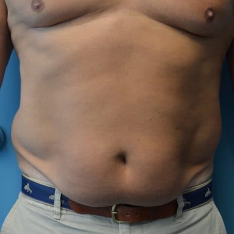 man with flabby stomach before undergoing bodytite radio frequency body contouring