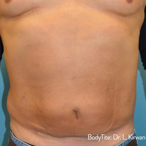 man showing results of bodytite treatment to tone flabby stomach