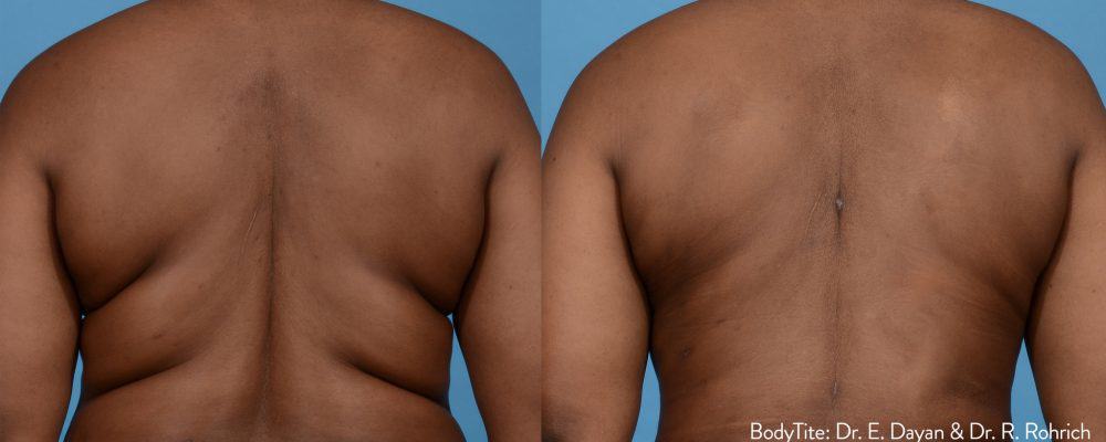 person showing results of bodytite treatment to reduce fat around the back area