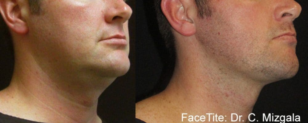 facetite results on a man's jawline and neck to add definition and tighten skin