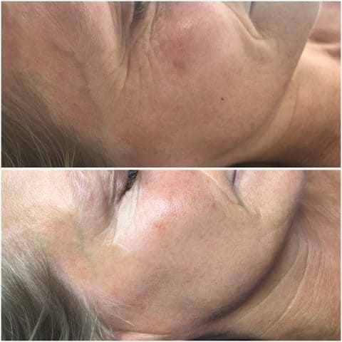 before and after of dermalux triwave therapy for skin rejuvenation