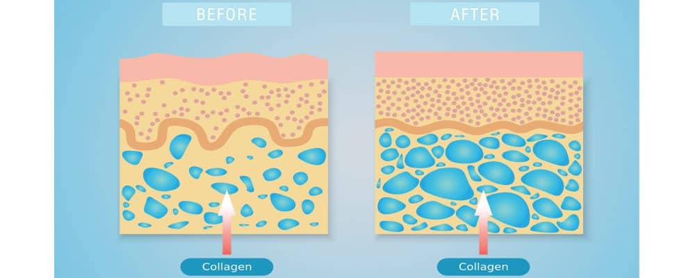 before and after illustration of lanluma collagen treatment on the skin