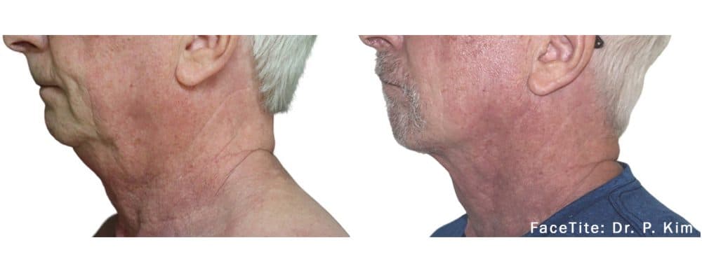 facetite adding definition to a mature man's chin before and after photos