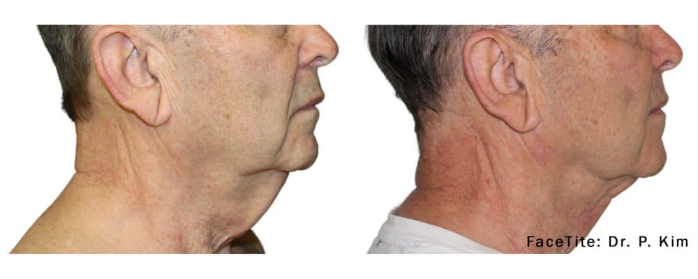 facetite treatment for a mature man to resolve sagging skin on the neck