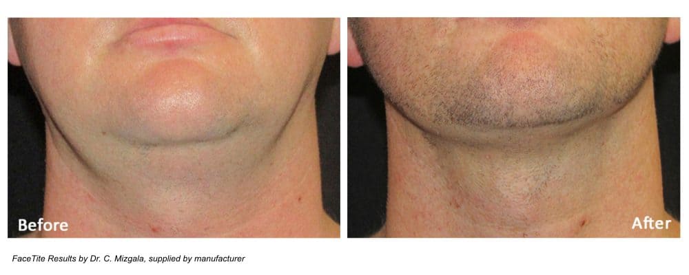 facetite for men results on double chin and jawline