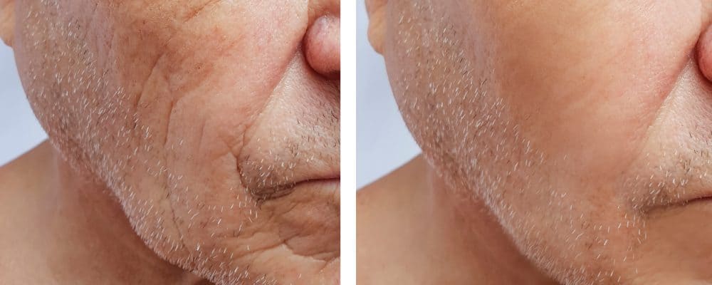 before and after images illustrating the results of filler and collagen treatments on the face