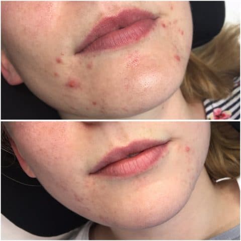 girl shows how dermalux led phototherapy helped her acne prone skin