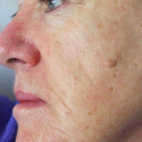 Woman in her 60s uses SKN REHAB Signature Facial treatment to combat ageing on her face