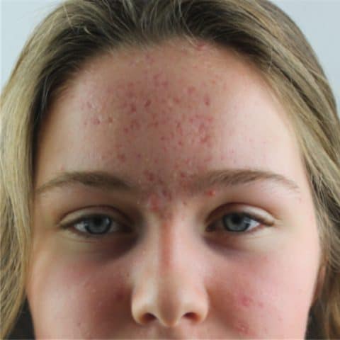 17-year old girl with acne scarring on her forehead