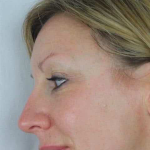 40-year-old woman showing the results of the SKN REHAB Signature Facial to combat early signs of agening