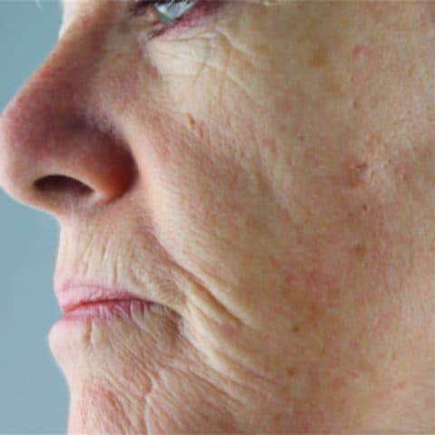 Woman in her 60s concerned about ageing and wrinkles in her face