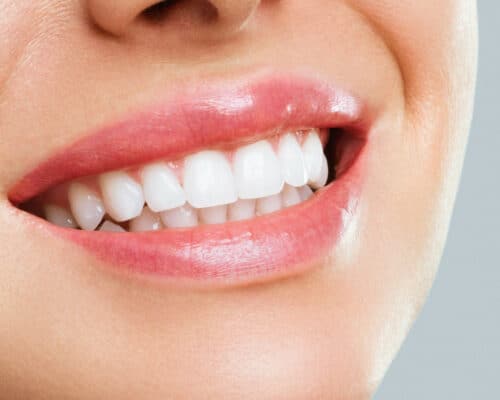 Teeth Whitening