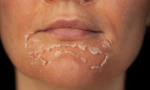 Peeling Skin: Everything You Need To Know