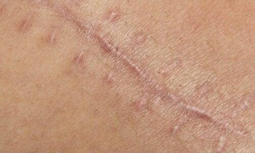 All About Treating Scars