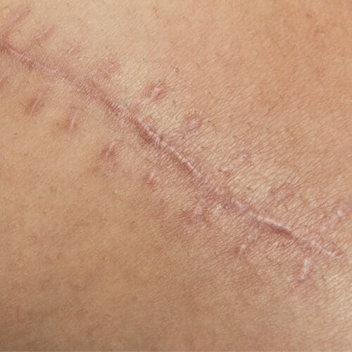 All About Treating Scars