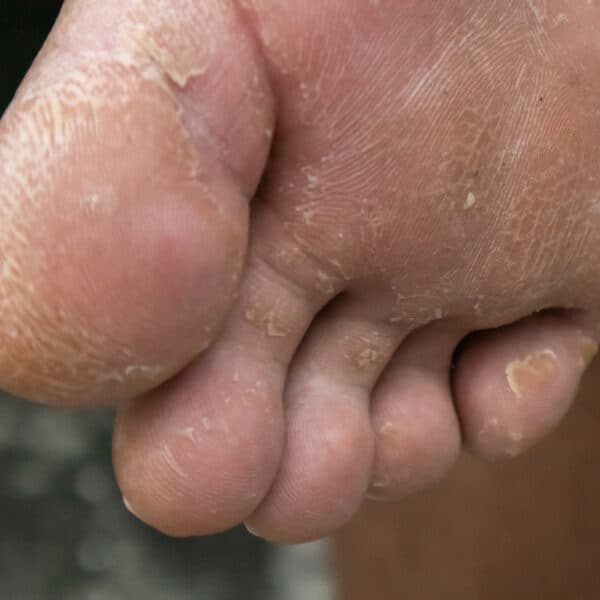 Peeling Skin