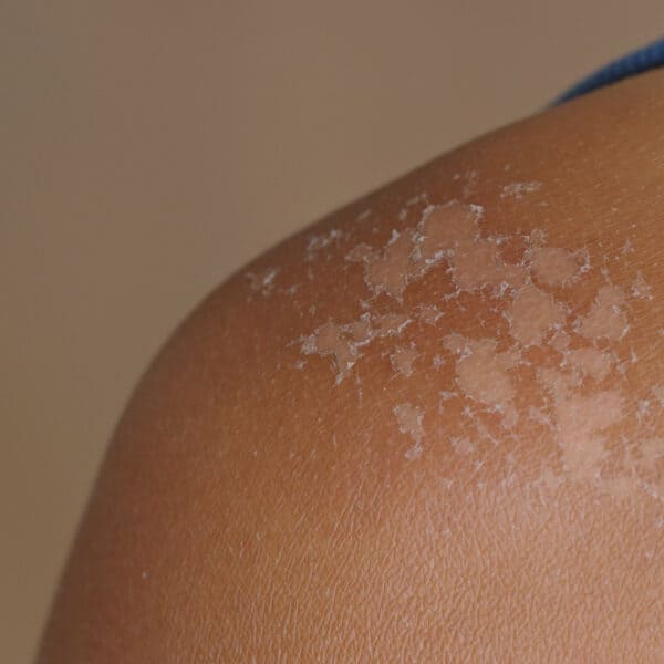 Peeling Skin